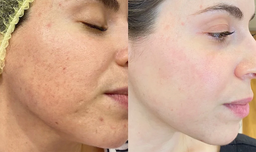 before after mesotherapy skin improvement mississauga oakville